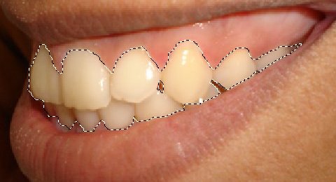 gimp – vybraná oblast zubů